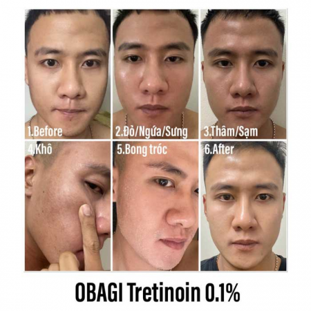 Review Hướng dẫn dùng Tretinoin Obagi đúng cách trong quy trình dưỡng da. Hướng dẫn Hướng dẫn dùng Tretinoin Obagi đúng cách trong quy trình dưỡng da tại Hà Nội , Đà Nẵng , TP. HCM | CỬA HÀNG LÀM ĐẸP™